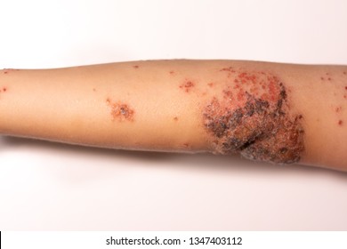 Impetigo On A Child's Arm