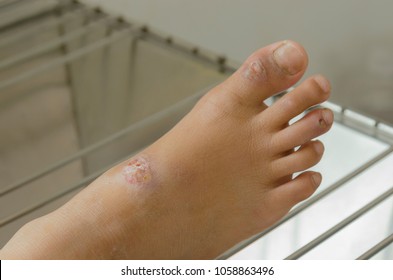 Impetigo Skin  Infection.