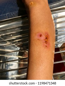 Impetigo Wound Care.