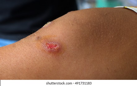 Impetigo Wound On Leg.