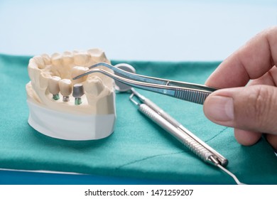 85 Dental implan Images, Stock Photos & Vectors | Shutterstock