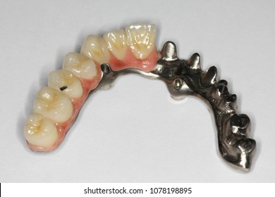 Implant bar and screw for the patient
