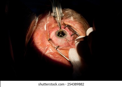 The Implant Of New Artificial Crystalline Lens In Cataract Surgery