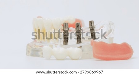 Implant Prosthesis Components Demonstrated on Transparent Jaw Model