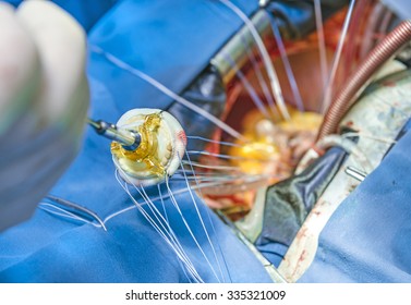 Implantation Of A Biological Heart Valve