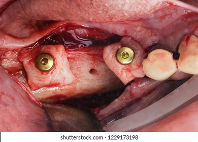 Implantation And Soft Tissue Build-up In The Gum Of The Jaw