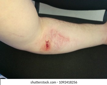 Bruise On Arm After Blood Donation Stock Photo 1312598363 | Shutterstock