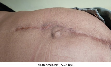 Previous Scar Stock Images, RoyaltyFree Images  Vectors  Shutterstock