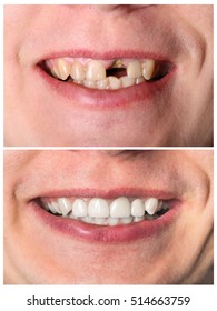 Incisive Man's Tooth Restoration Before And After Treatment