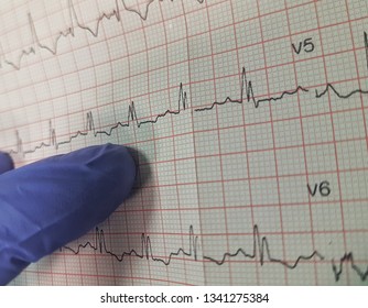 Incorrect Ecg Record. Bundle Branch Block In The Electrocardiographic Record