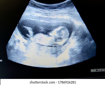 increased nuchal translucency in fetus by ultrasound - Shutterstock ID 1786926281