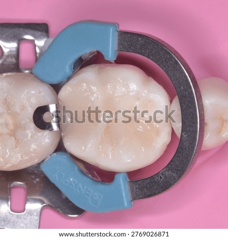 Incremental Placement of Direct Composite 