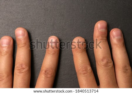 index finger after hand surgery. Damaged finger. after gangrene