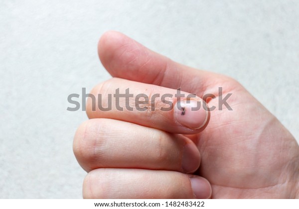 Index Finger Subungual Hematoma Painful Nail Stock Photo Edit Now