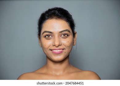 Indian Smiling Woman With Her Pimples, Acne And Dark Spots.
Every Woman Look Beautiful Concept, Skincare, Cosmetology
Concept Isolated On Gray Background