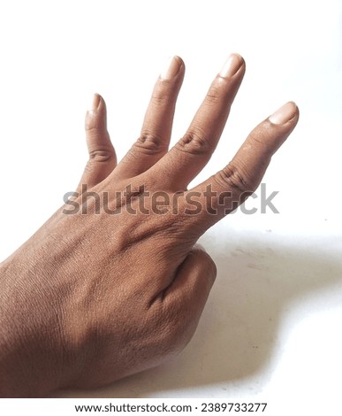 Indonesian man's left hand with mallet finger. On a white background.