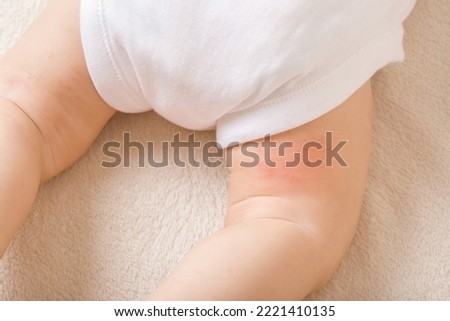 Infant bare leg with red rash on skin. Suffering from allergy of milk formula, mother milk or other food. Care about baby body. Closeup. Top down view.