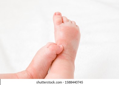 Infant Legs With Red Dry Skin. Suffering From Allergy Of Milk Formula Or Other Food. Closeup.