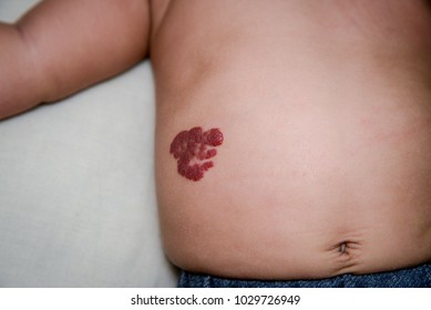 Hemangioma Images Stock Photos Vectors Shutterstock