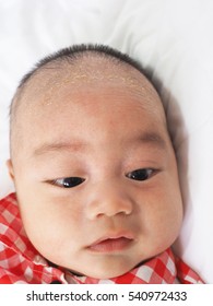 Infantile Seborrheic Dermatitis