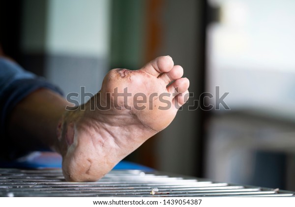 Infected Diabetic Foot Ulcerselective Focus Stock Photo 1439054387 ...