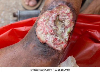 Infected diabetic wounds on legs of the patient.Deep wound to tendons and bones.Complications from diabetes related to the nervous system and blood vessels are the leading causes of diabetic ulcers.
