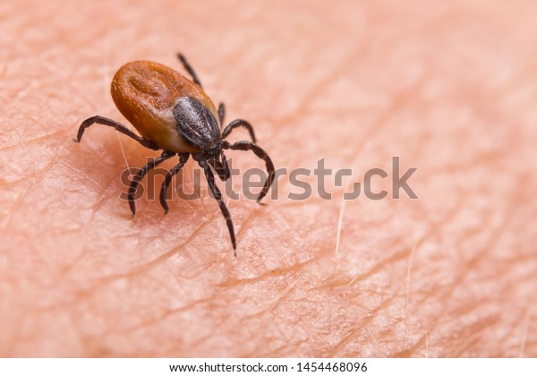 Infected female deer tick on hairy human skin.
Ixodes ricinus. Parasitic mite. Acarus. Dangerous biting insect on
background of epidermis detail. Disgusting carrier of infections.
Tick-borne diseases.