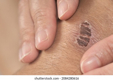Infected scab on the kneee injured from accident - Shutterstock ID 2084280616