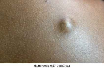 Infected Sebaceous Cyst