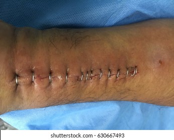 surgical wound images stock photos vectors shutterstock