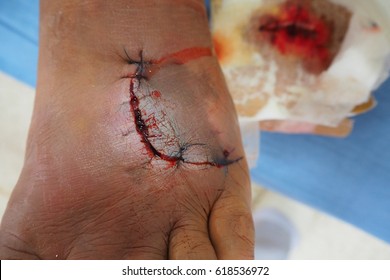 Infected wound after stitches wound