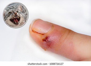 infected wound of a cat bite in the finger. very often a bite declines into a sepsis