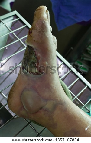 infected wound with diabetes foot that turn into necrotizing fasciitis or Flesh-eating disease , a severe infectious disease that need urgent surgical treatment. Medical and healthcare shot.