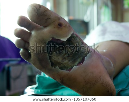 infected wound with diabetes foot that turn into necrotizing fasciitis or Flesh-eating disease , a severe infectious disease that need urgent surgical treatment. Medical and healthcare shot.