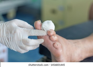 Infected Wound Diabetic Foot Stock Photo 1456831445 | Shutterstock