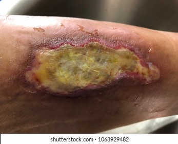 Infected wound diabetic foot with wound burn from hot water. Medical and healthcare concept.