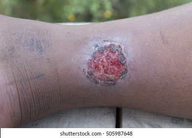 Infected wound on leg.