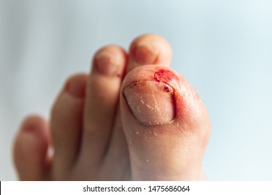 Stubbed toe purple
