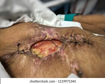 Infected Wound With Stent Graft At Femoral Artery. Medical And Healthcare Concept.