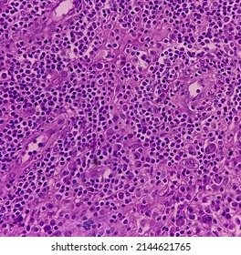 Infected wound tissue: Foreign body granuloma, skin, subepithelial tissue show granuloma, dense infiltration of polymorphs, lymphocyte, histiocytes and plasma cells.
