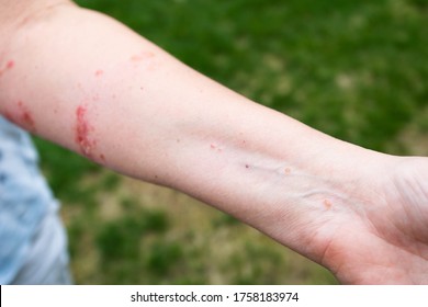 Infection And Poison Ivy Allergic Reaction On Woman's Arm And Forearm.