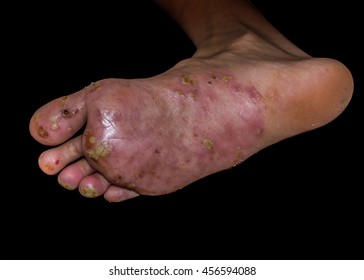 Infection Wound Of Foot