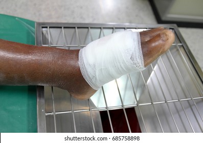 Infection Wound On Diabetic Patient Foot , Swell Foot, Gauze Bandage