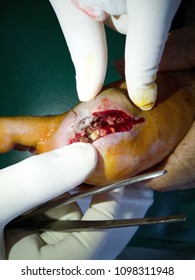 Infection Wound In Patient Of Diabetic And Peripheral Artery Disease. Post Big Toe Amputation.