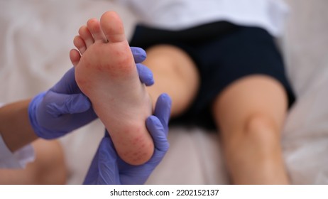 Infectious Disease Doctor Examining Rash On Skin Of Child Feet Closeup