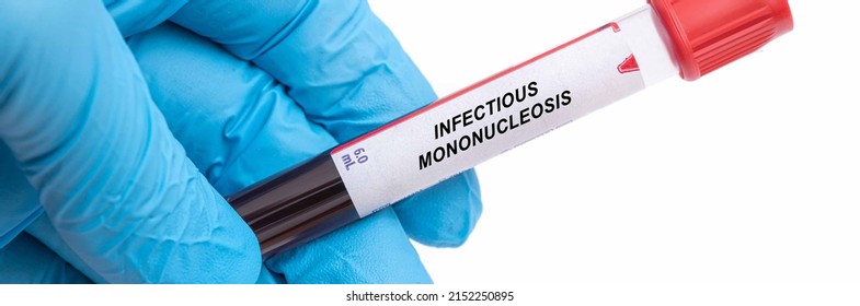 infectious-mononucleosis-infectious-mononucleosis-disease-blood-stock