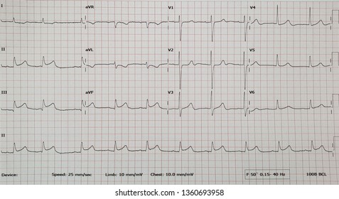 Inferior wall STEMI with PAC. - Shutterstock ID 1360693958