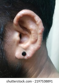 Infiltrated Ear Lobe In Lepromatous Leprosy