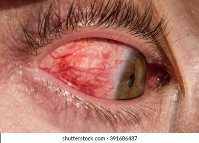 Inflamed Eye