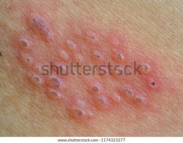 Inflamed Infected Skin Cause Widespread Red Stock Photo (Edit Now